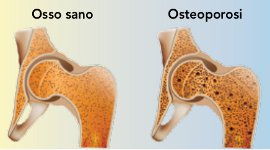 Osteoporosi